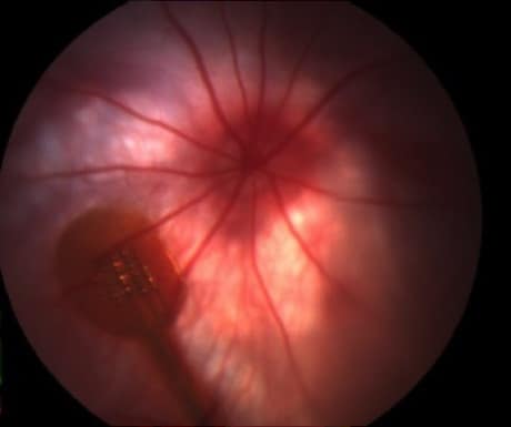 Retinal implant in a rat's eye