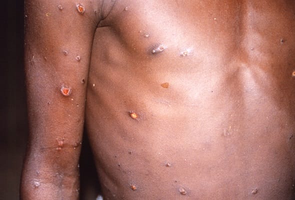 First case of deadly mpox Clade Ib found in London – London Business News | Londonlovesbusiness.com